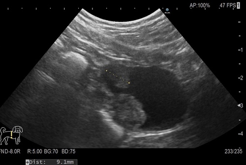 膀胱移行上皮癌超音波検査画像.jpg