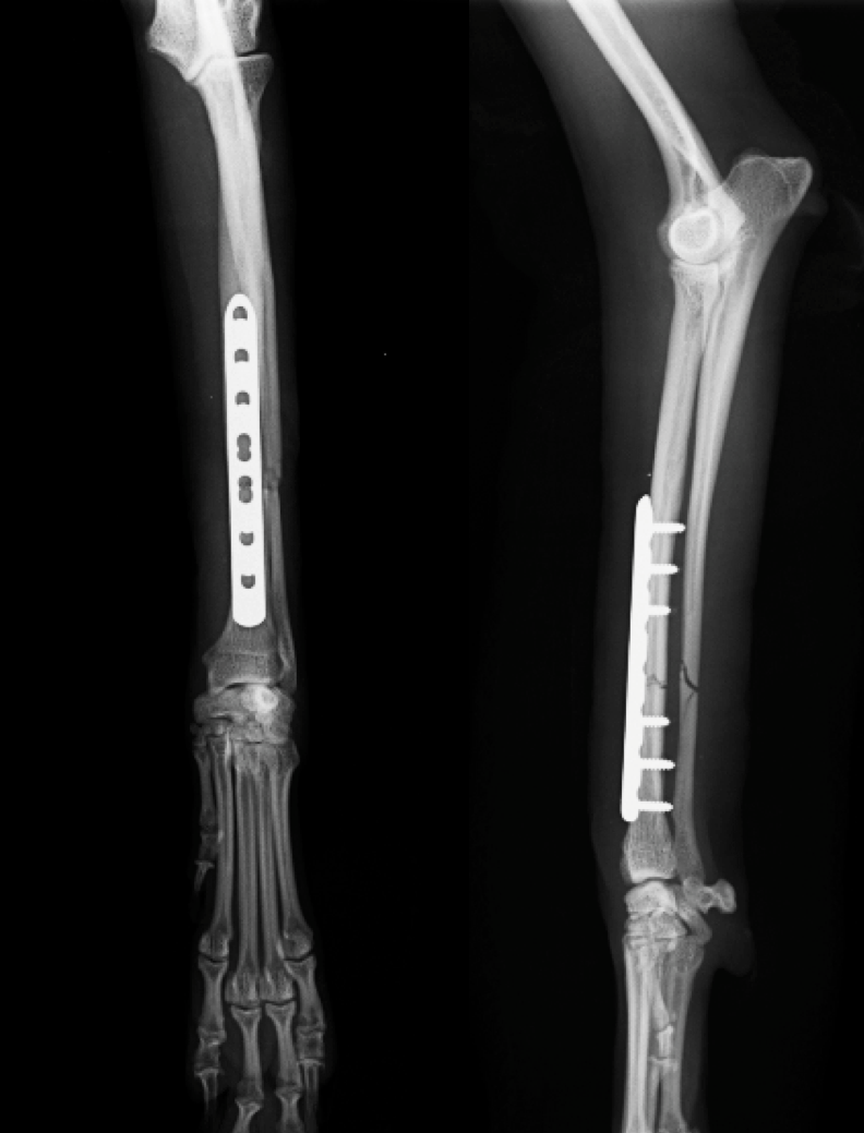 橈骨尺骨骨折TプードルSYNTHES社製VP LCP ストレート 2.0 長 55mm 8穴 を用いて治療＞